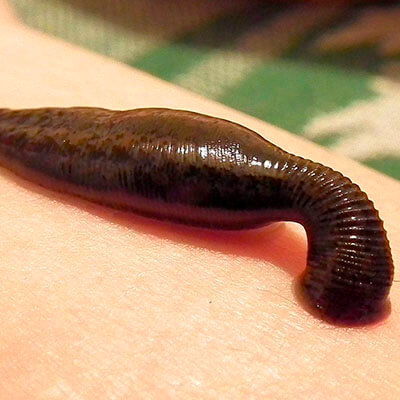 girudoterapiya